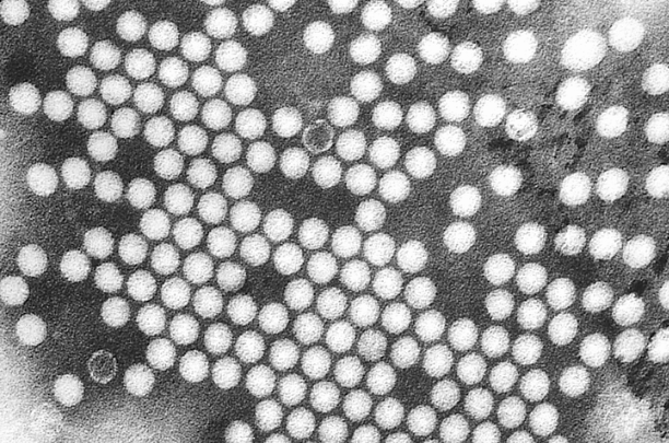 Détection d’un poliovirus dérivé d’une souche vaccinale de type 2 (PVDV2) dans les eaux usées à Londres